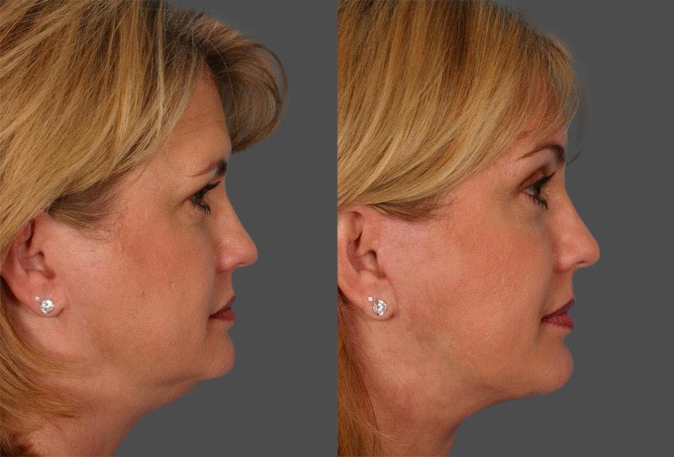 Endoscopic Brow Lift Before & After Gallery - Patient 290149 - Image 3