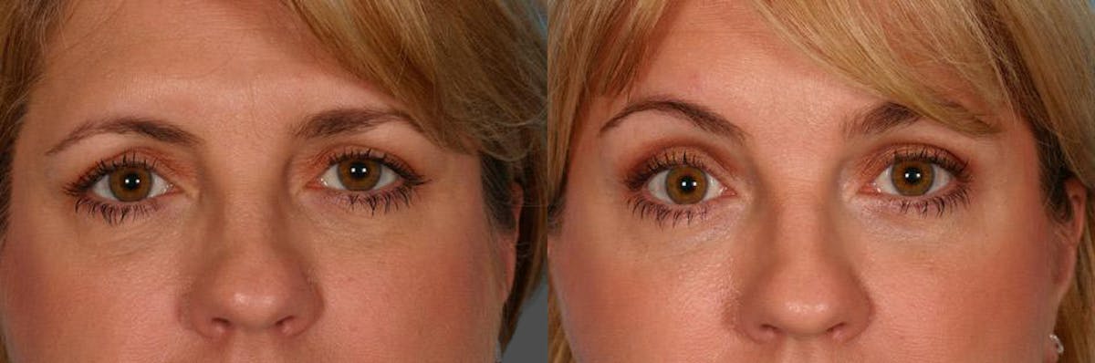 Endoscopic Brow Lift Before & After Gallery - Patient 290149 - Image 4