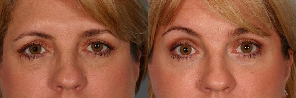 Endoscopic Brow Lift Before & After Gallery - Patient 290149 - Image 4