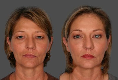 Endoscopic Brow Lift Before & After Gallery - Patient 348487 - Image 1