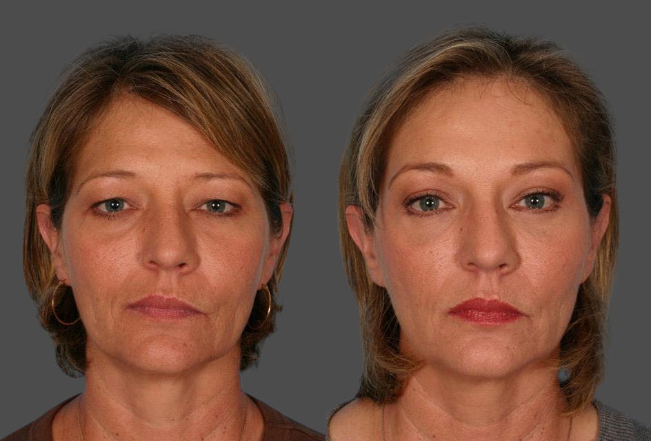Endoscopic Brow Lift Before & After Gallery - Patient 348487 - Image 1
