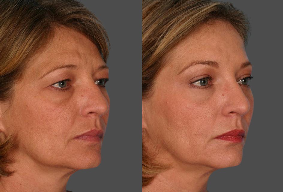 Endoscopic Brow Lift Before & After Gallery - Patient 348487 - Image 2