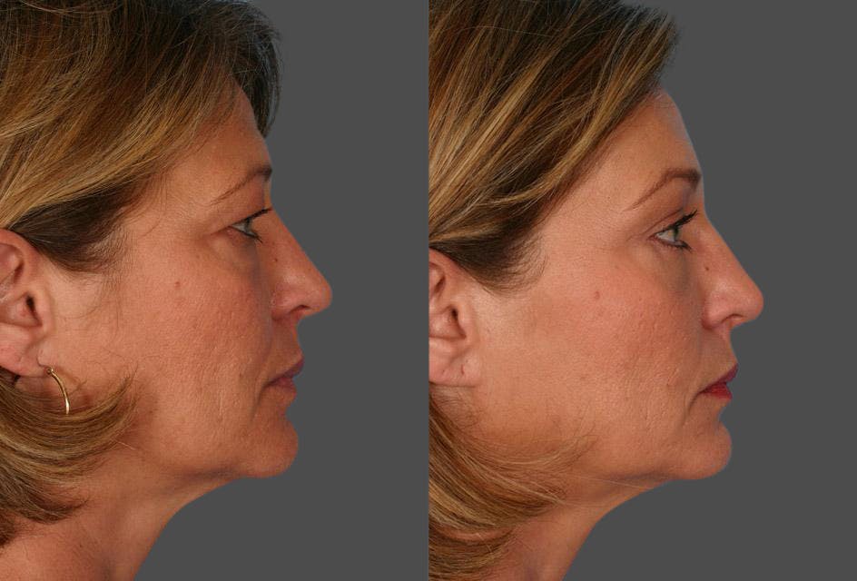 Endoscopic Brow Lift Before & After Gallery - Patient 348487 - Image 3