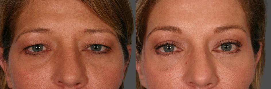 Endoscopic Brow Lift Before & After Gallery - Patient 348487 - Image 4