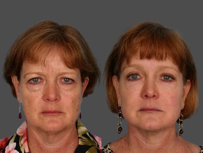 Endoscopic Brow Lift Before & After Gallery - Patient 348502 - Image 1