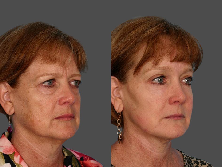 Endoscopic Brow Lift Before & After Gallery - Patient 348502 - Image 2