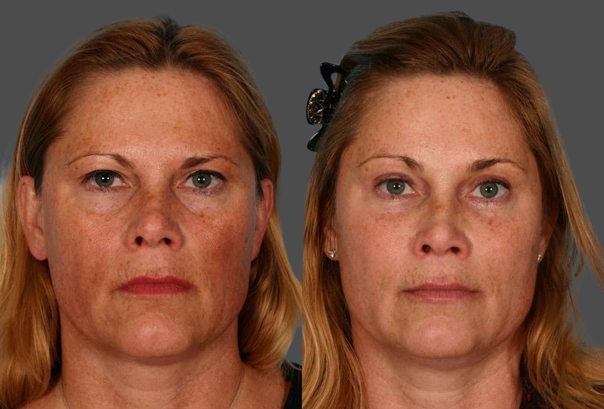 Endoscopic Brow Lift Before & After Gallery - Patient 370813 - Image 1
