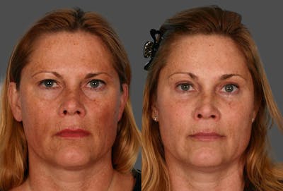 Endoscopic Brow Lift Before & After Gallery - Patient 370813 - Image 1