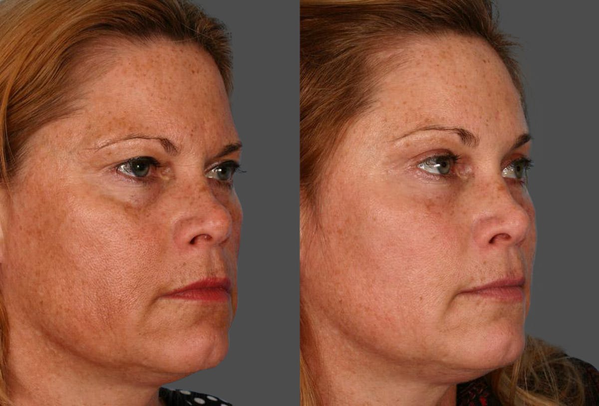 Endoscopic Brow Lift Before & After Gallery - Patient 370813 - Image 2