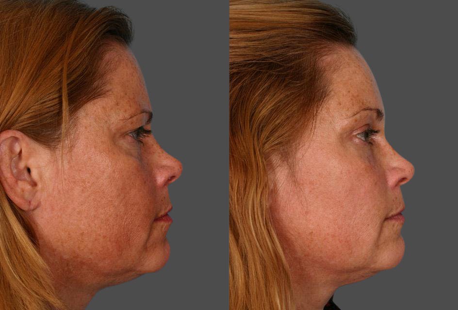 Endoscopic Brow Lift Before & After Gallery - Patient 370813 - Image 3