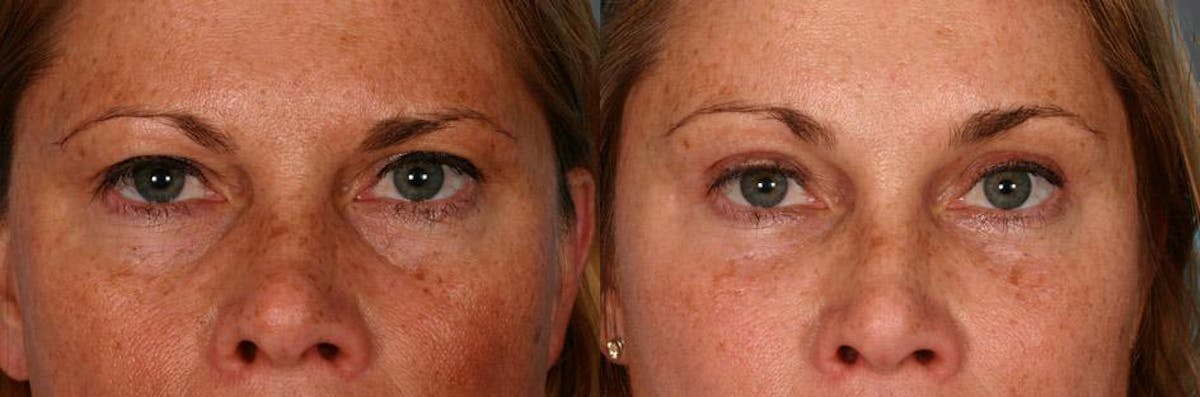Endoscopic Brow Lift Before & After Gallery - Patient 370813 - Image 4