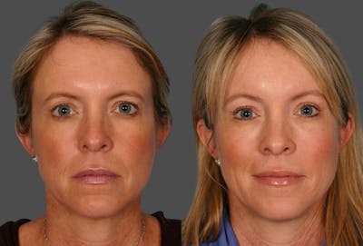 Endoscopic Brow Lift Before & After Gallery - Patient 380900 - Image 1