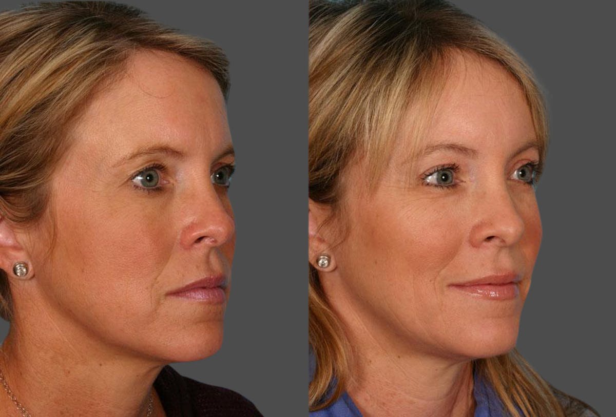 Endoscopic Brow Lift Before & After Gallery - Patient 380900 - Image 2
