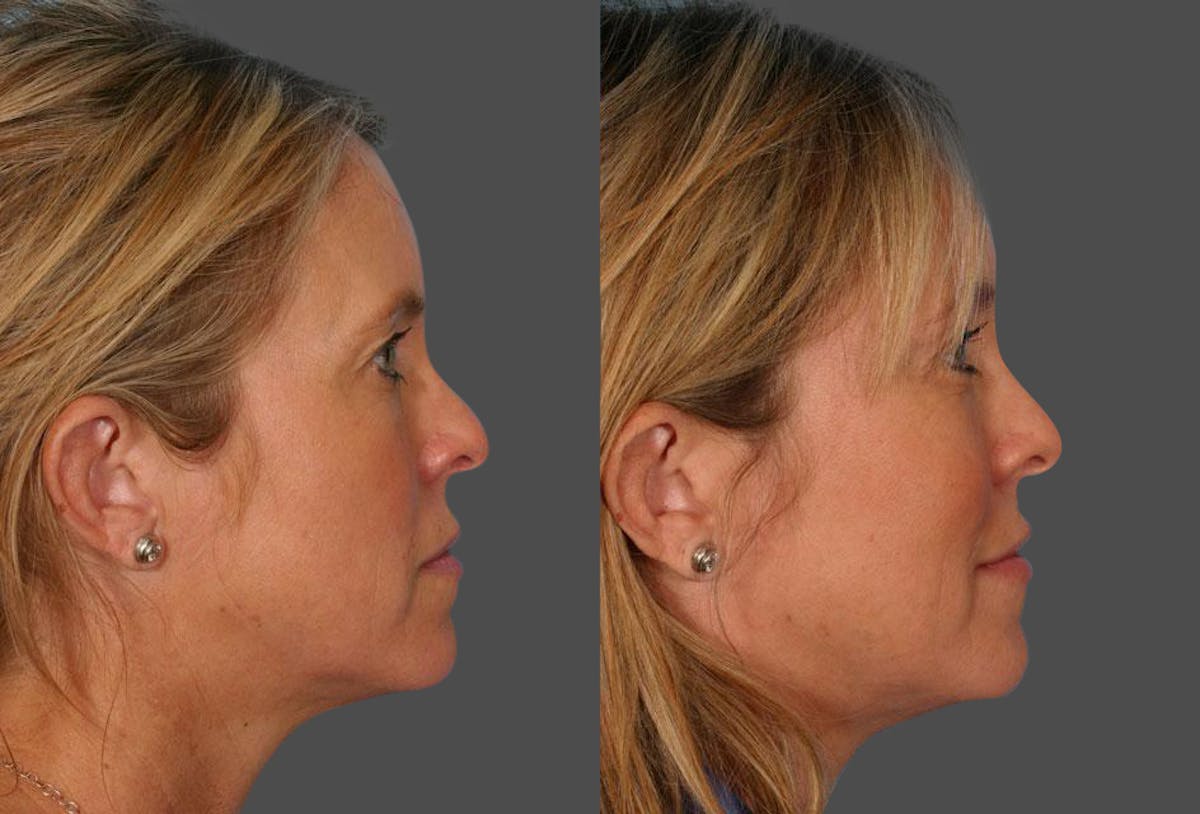 Endoscopic Brow Lift Before & After Gallery - Patient 380900 - Image 3