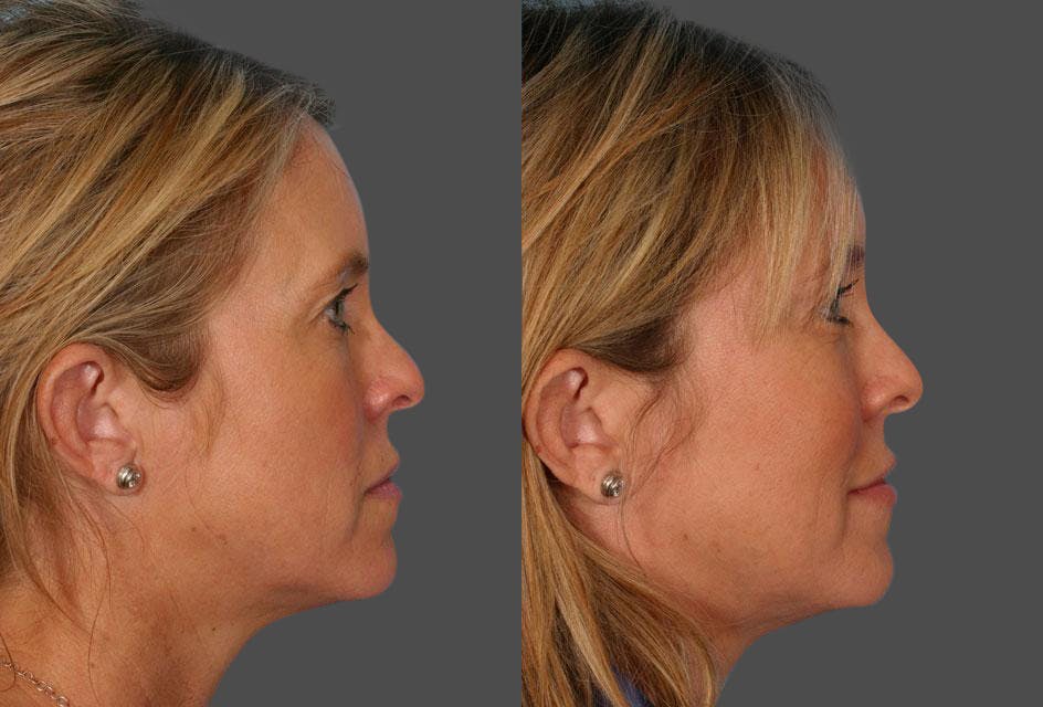 Endoscopic Brow Lift Before & After Gallery - Patient 380900 - Image 3