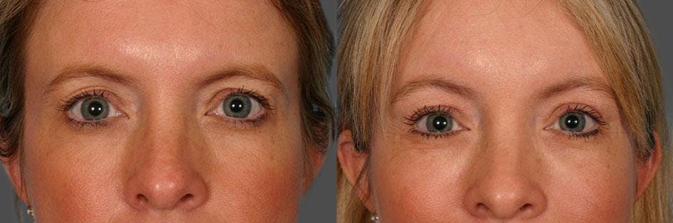Endoscopic Brow Lift Before & After Gallery - Patient 380900 - Image 4