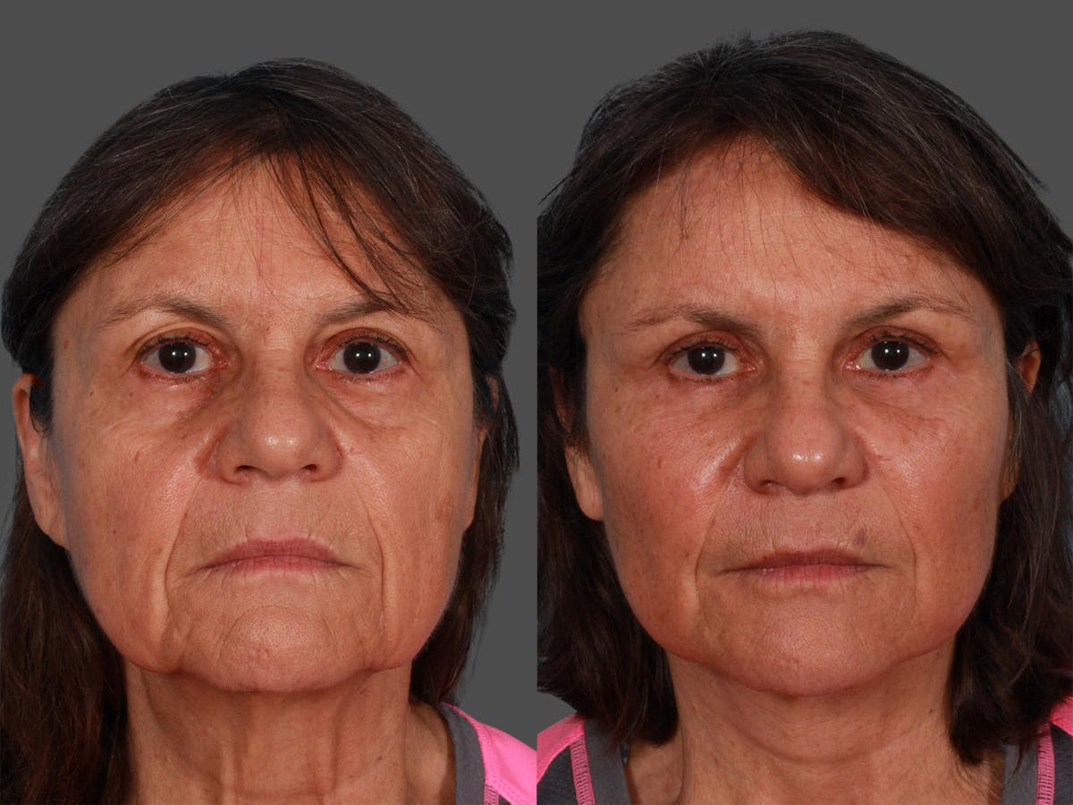 Endoscopic Brow Lift Before & After Gallery - Patient 416183 - Image 1