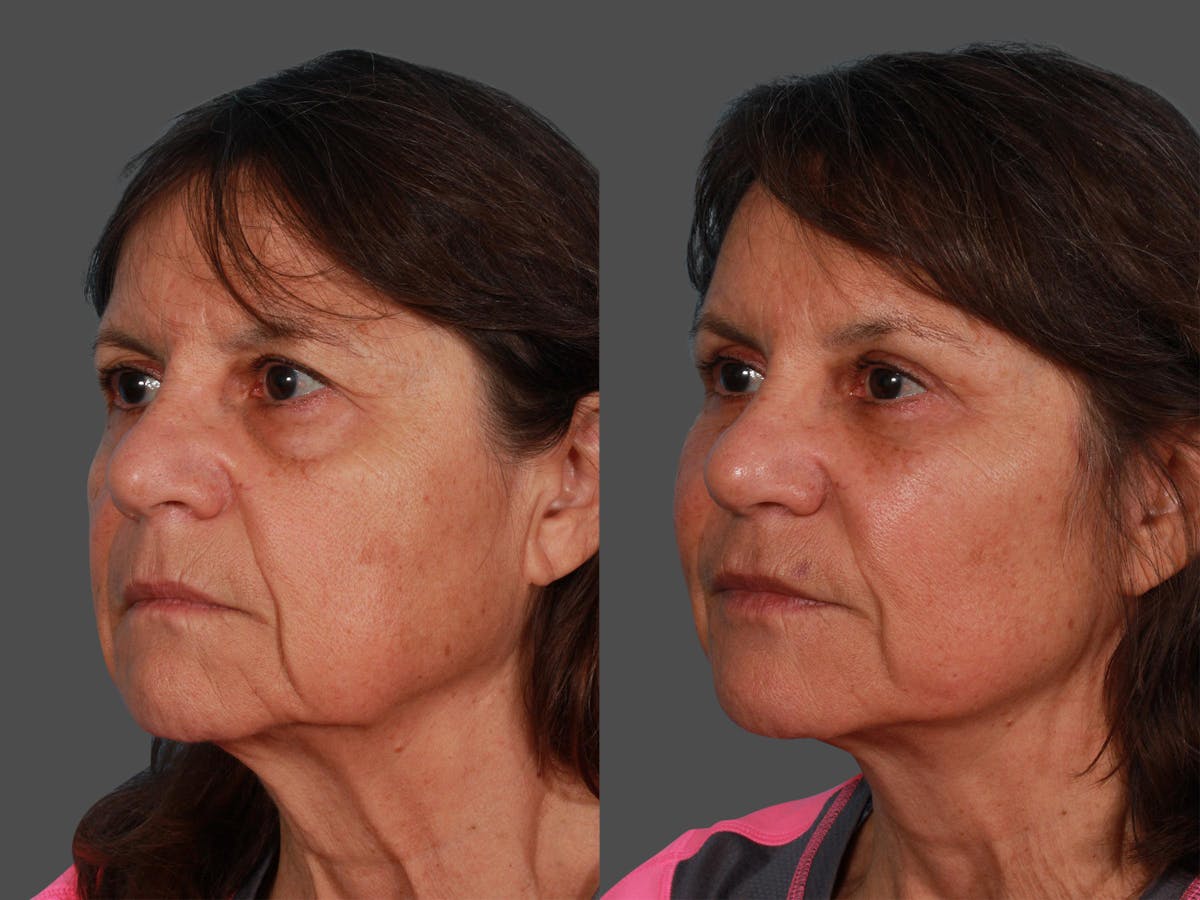 Endoscopic Brow Lift Before & After Gallery - Patient 416183 - Image 3