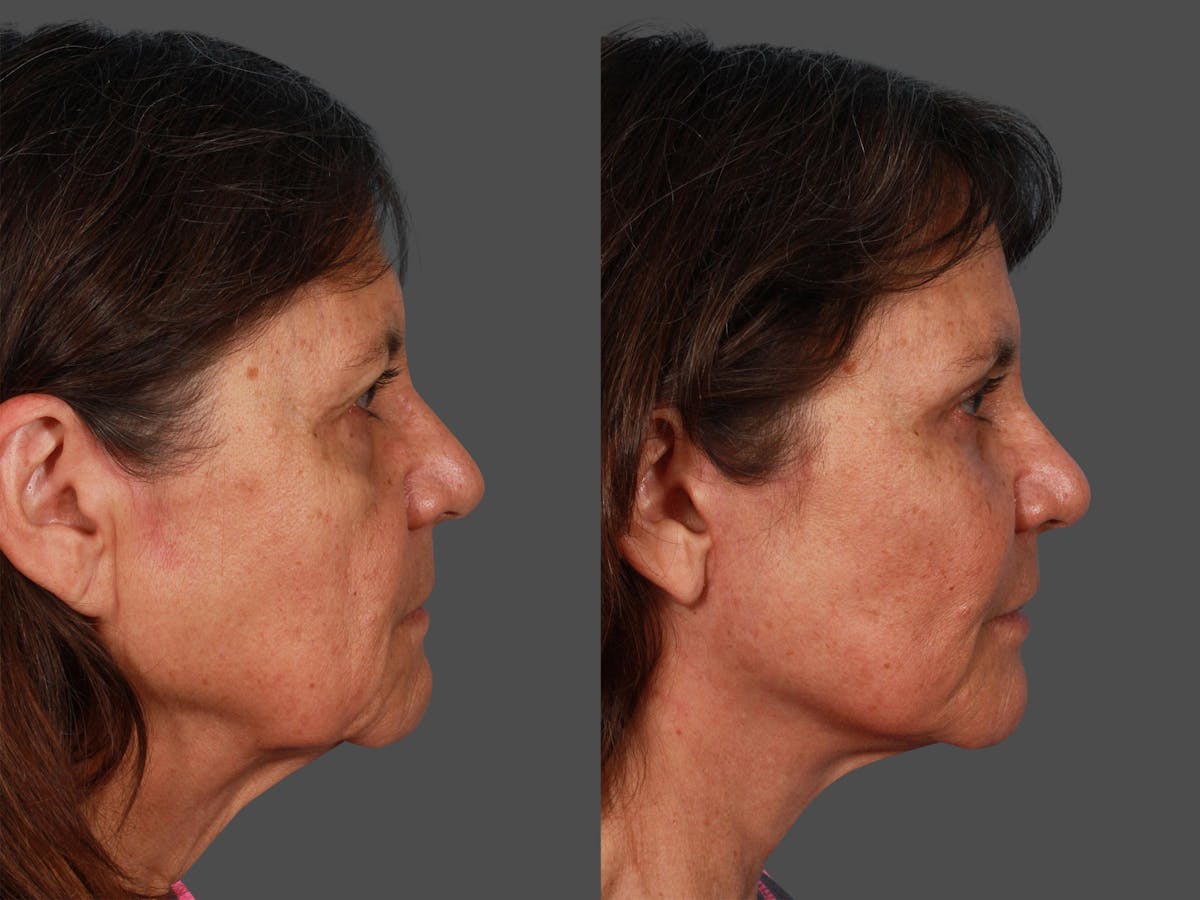 Endoscopic Brow Lift Before & After Gallery - Patient 416183 - Image 2