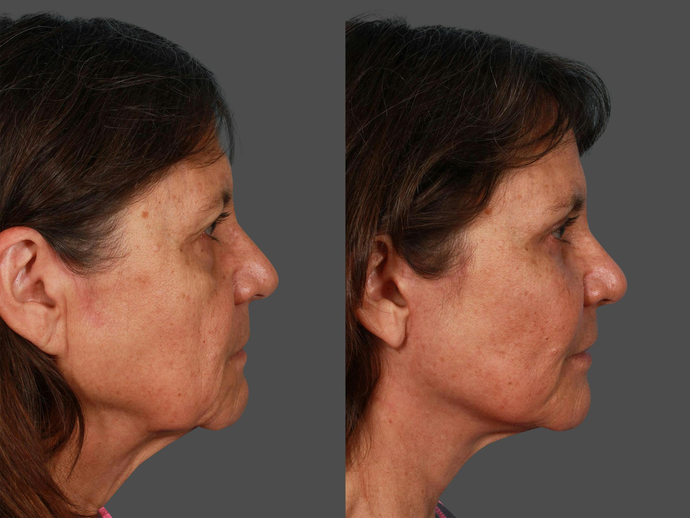 Endoscopic Brow Lift Before & After Gallery - Patient 416183 - Image 2