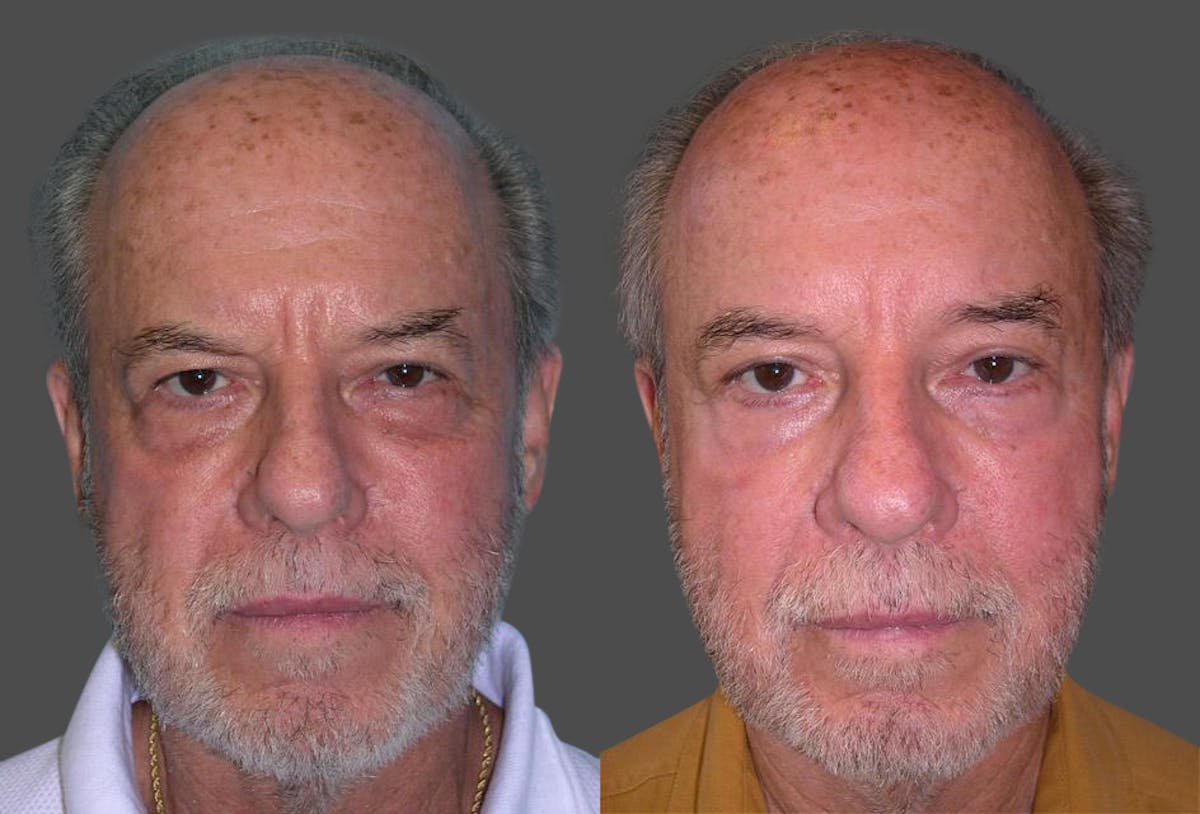 Endoscopic Brow Lift Before & After Gallery - Patient 619864 - Image 1