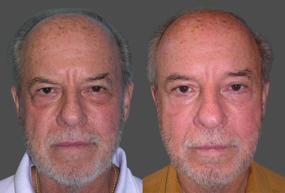 Endoscopic Brow Lift Before & After Gallery - Patient 619864 - Image 1