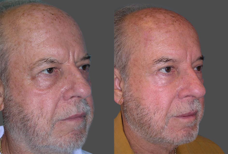 Endoscopic Brow Lift Before & After Gallery - Patient 619864 - Image 2