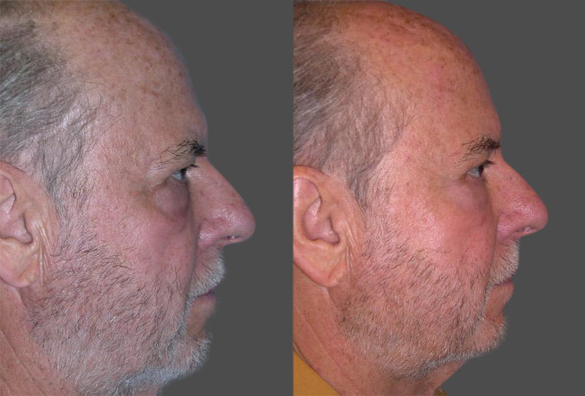 Endoscopic Brow Lift Before & After Gallery - Patient 619864 - Image 3