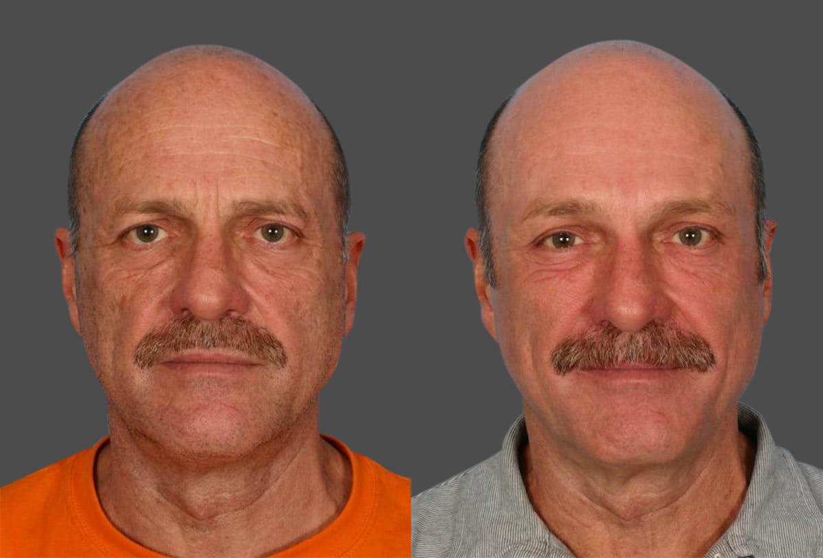 Endoscopic Brow Lift Before & After Gallery - Patient 823519 - Image 1