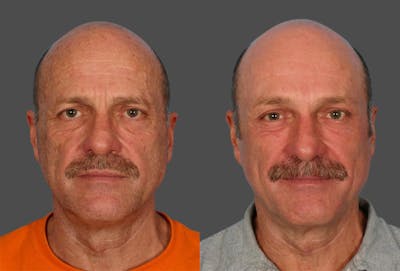 Endoscopic Brow Lift Before & After Gallery - Patient 823519 - Image 1