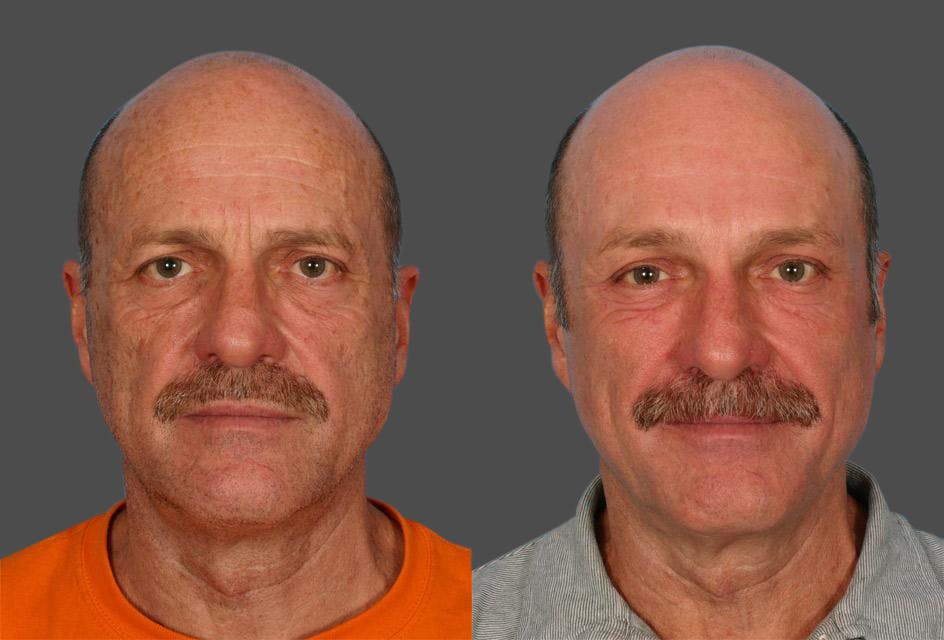 Endoscopic Brow Lift Before & After Gallery - Patient 823519 - Image 1