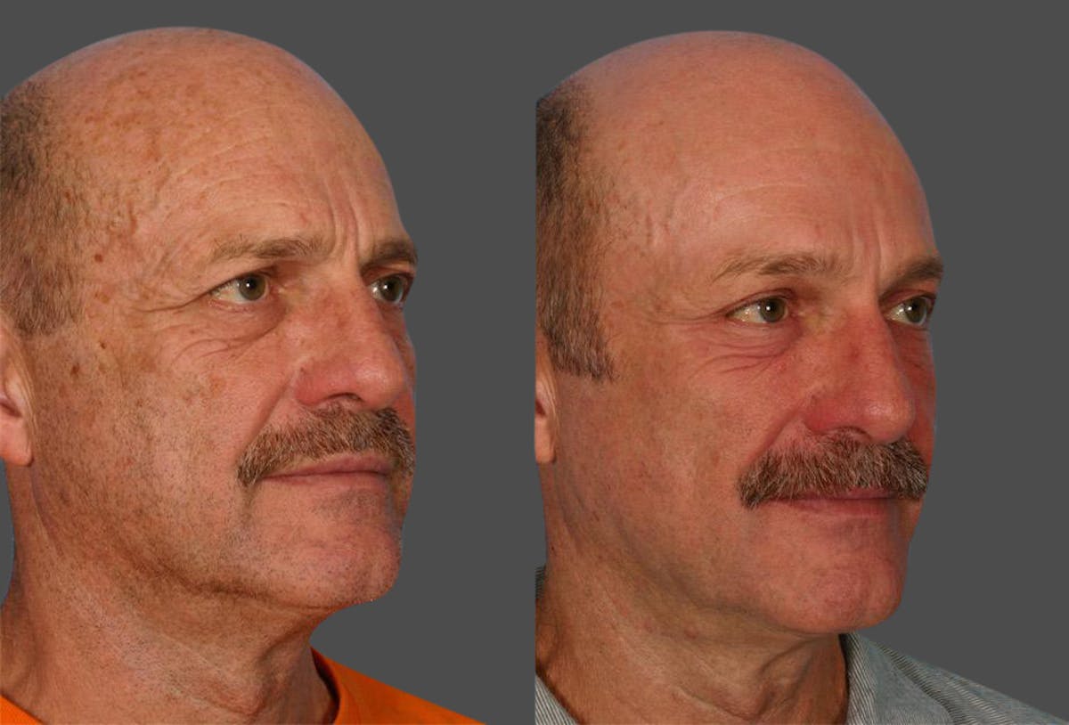 Endoscopic Brow Lift Before & After Gallery - Patient 823519 - Image 2