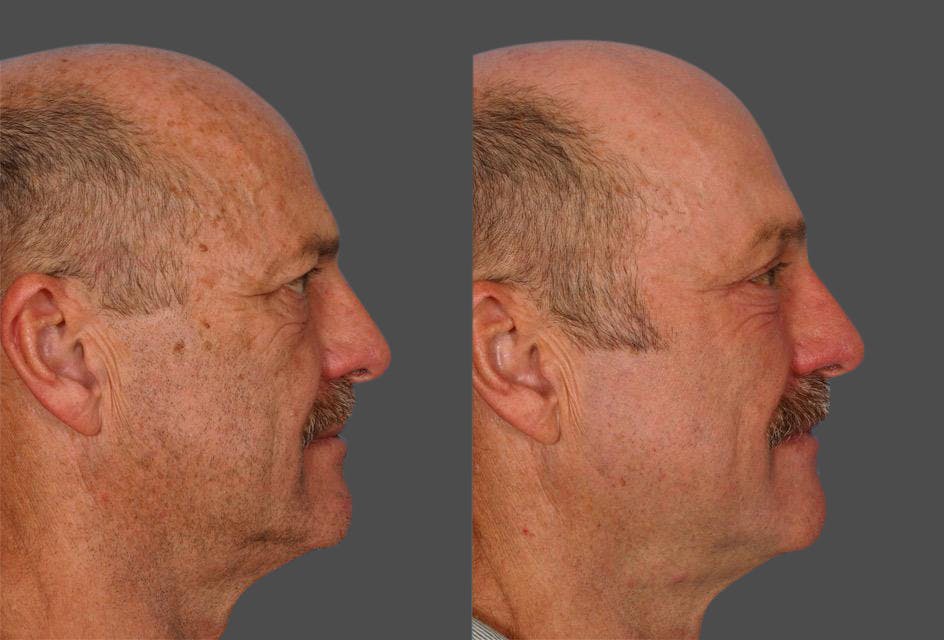 Endoscopic Brow Lift Before & After Gallery - Patient 823519 - Image 3