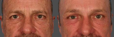Endoscopic Brow Lift Before & After Gallery - Patient 823519 - Image 4