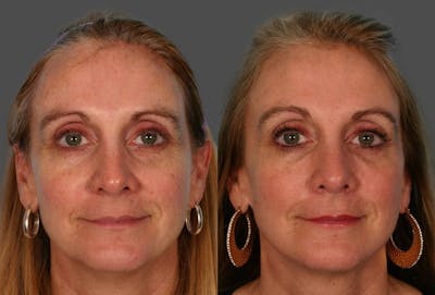CO2 Fractional Laser Before & After Gallery - Patient 363487 - Image 1