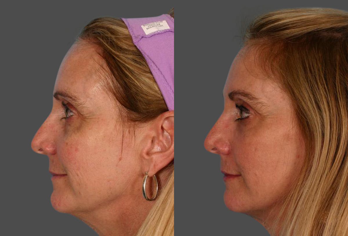 CO2 Fractional Laser Before & After Gallery - Patient 363487 - Image 2