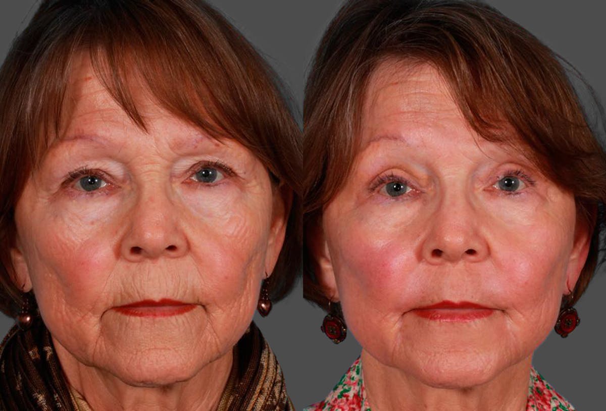 CO2 Fractional Laser Before & After Gallery - Patient 424988 - Image 1