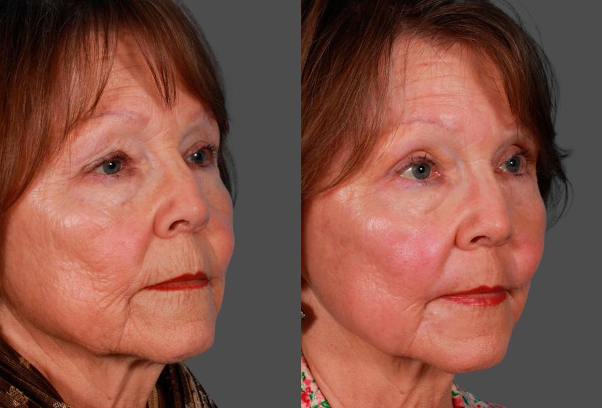 CO2 Fractional Laser Before & After Gallery - Patient 424988 - Image 2
