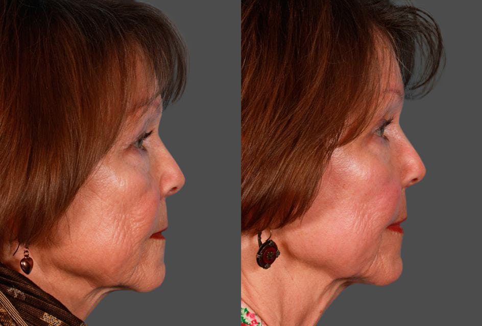 CO2 Fractional Laser Before & After Gallery - Patient 424988 - Image 3