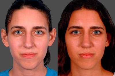 Rhinoplasty Before & After Gallery - Patient 180970 - Image 1