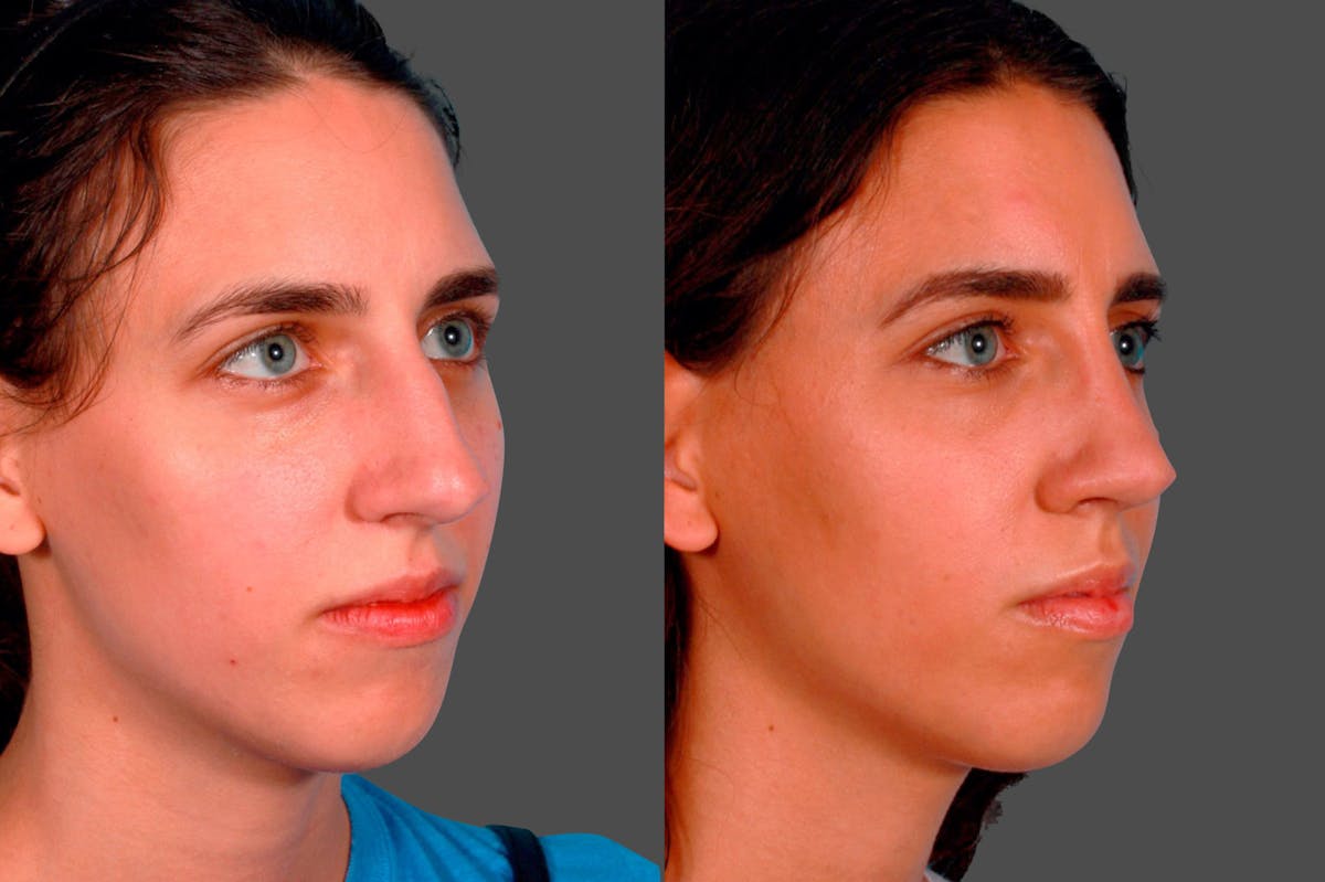 Rhinoplasty Before & After Gallery - Patient 180970 - Image 2