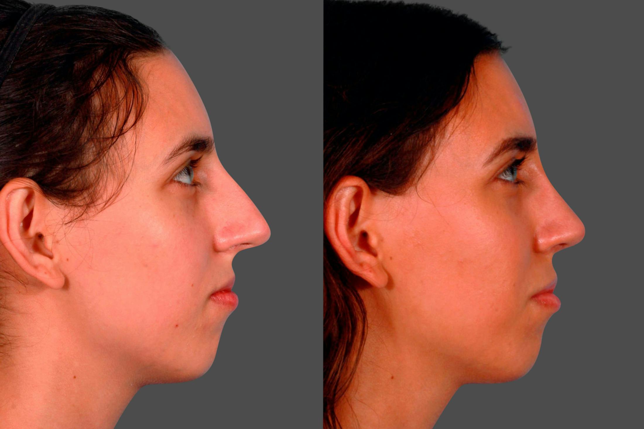 Rhinoplasty Before & After Gallery - Patient 180970 - Image 3