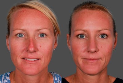 Rhinoplasty Before & After Gallery - Patient 124474 - Image 1