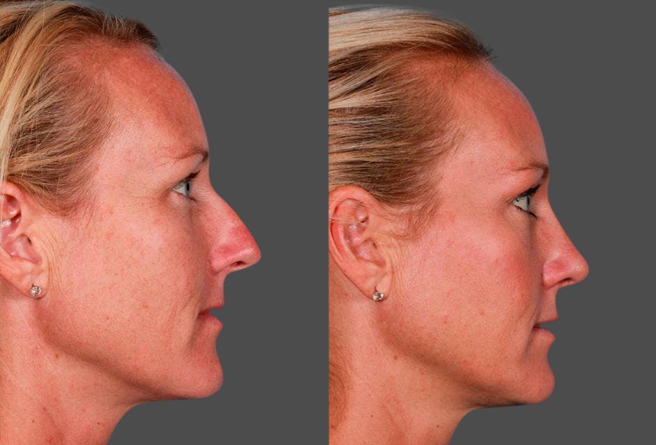 Rhinoplasty Before & After Gallery - Patient 124474 - Image 2