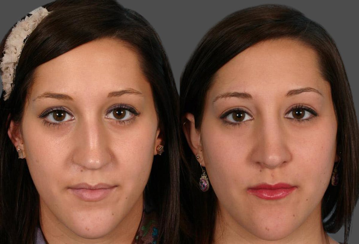 Rhinoplasty Before & After Gallery - Patient 389038 - Image 1