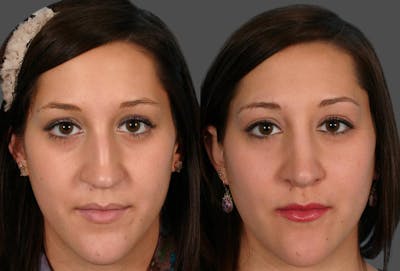 Rhinoplasty Before & After Gallery - Patient 389038 - Image 1