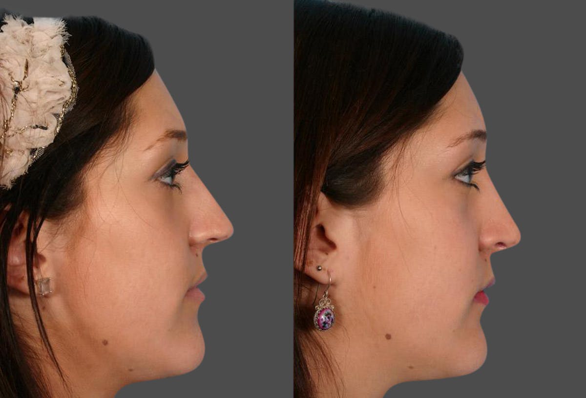 Rhinoplasty Before & After Gallery - Patient 389038 - Image 2