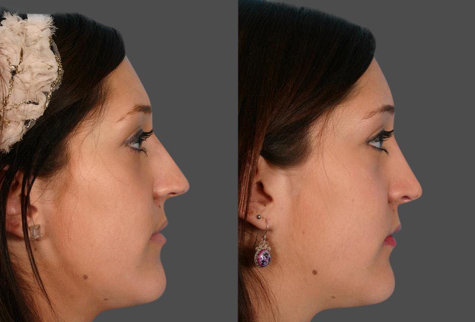Rhinoplasty Before & After Gallery - Patient 389038 - Image 2