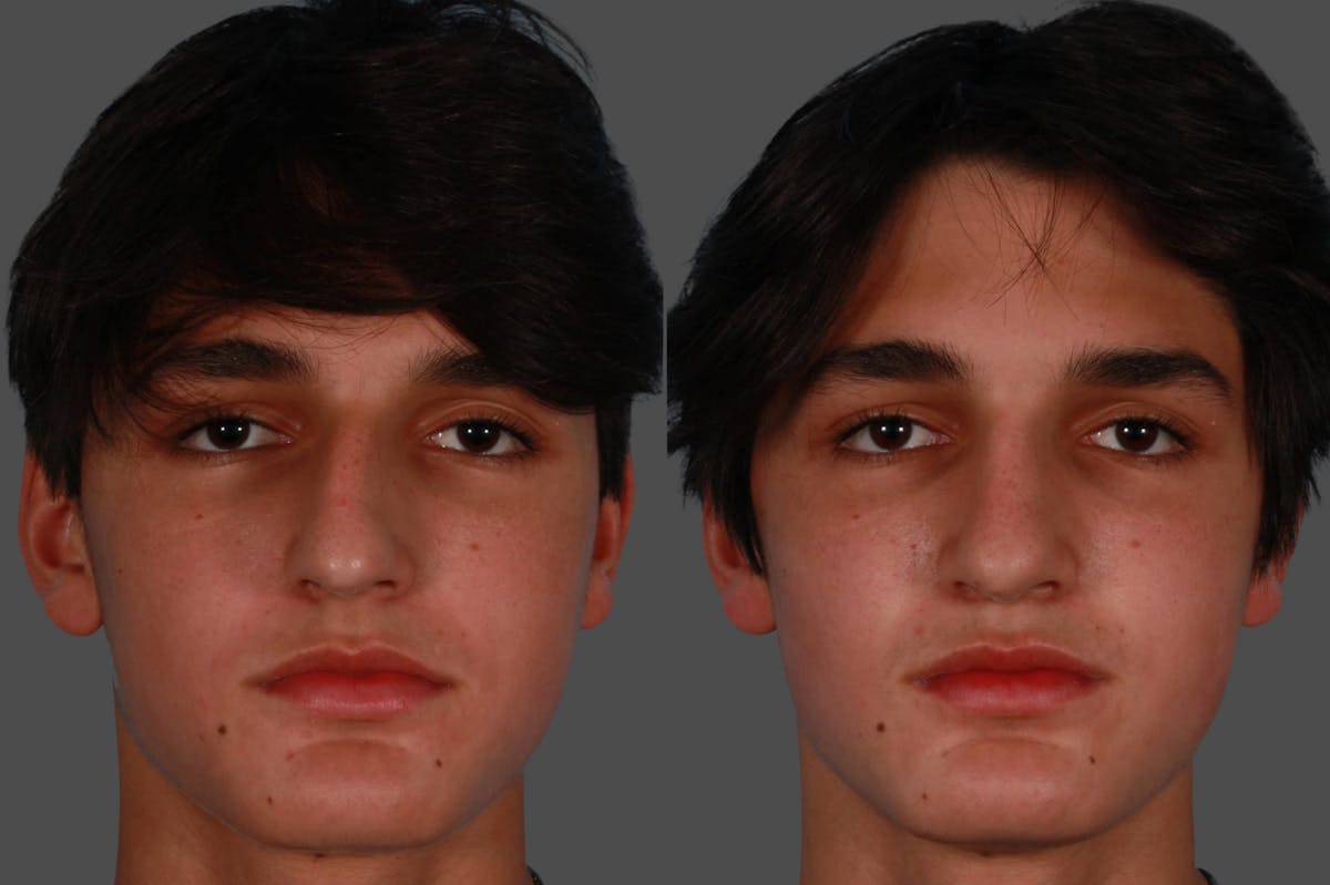 Rhinoplasty Before & After Gallery - Patient 376565 - Image 1