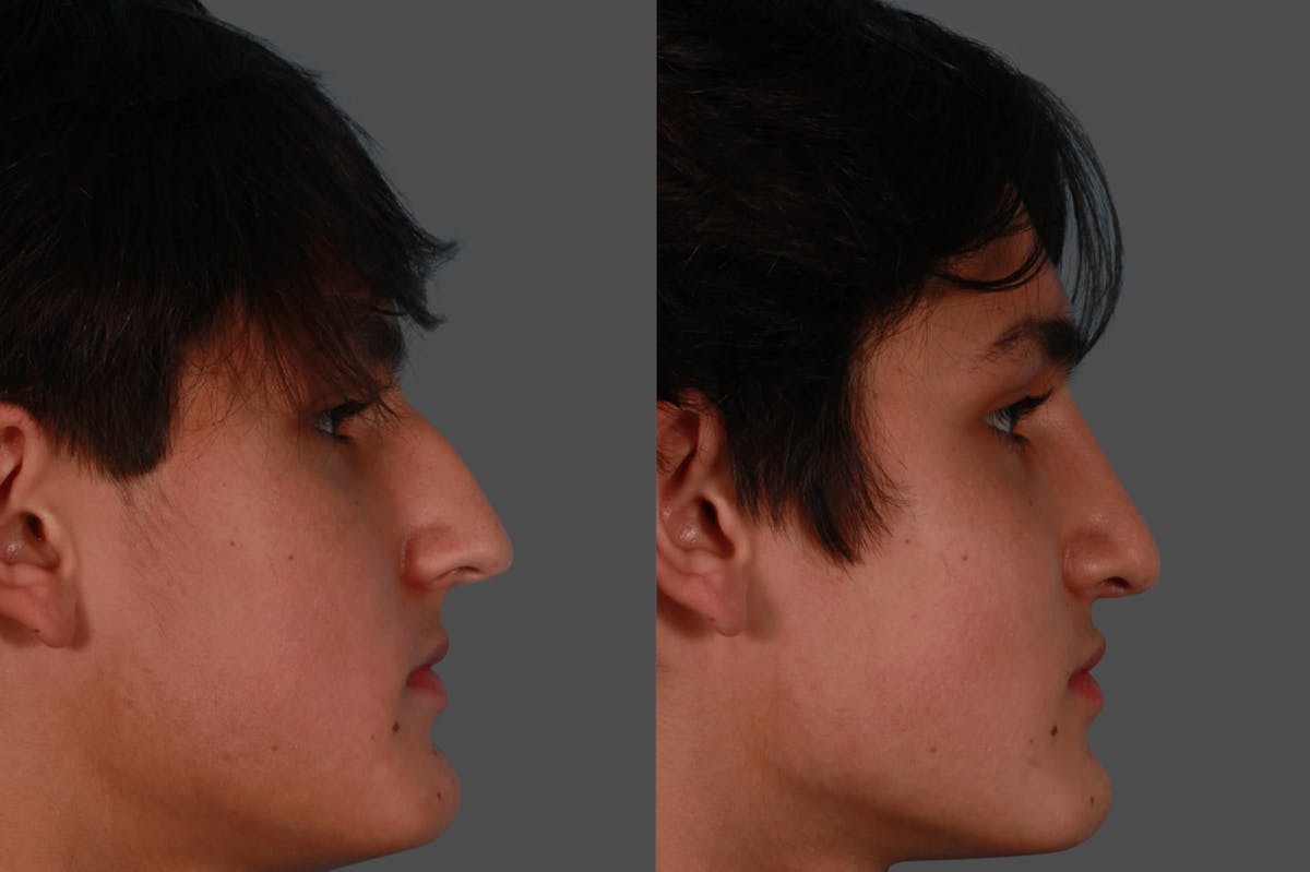 Rhinoplasty Before & After Gallery - Patient 376565 - Image 2